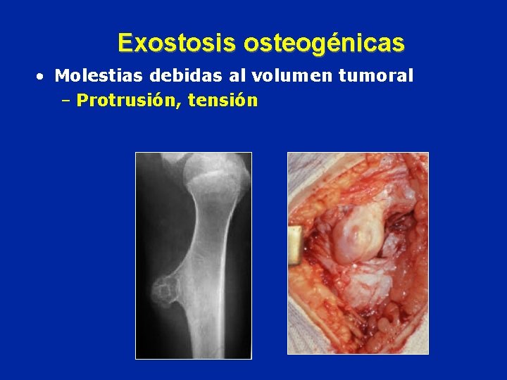 Exostosis osteogénicas • Molestias debidas al volumen tumoral – Protrusión, tensión 