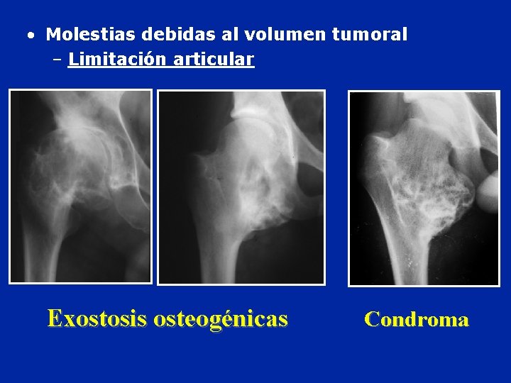  • Molestias debidas al volumen tumoral – Limitación articular Exostosis osteogénicas Condroma 