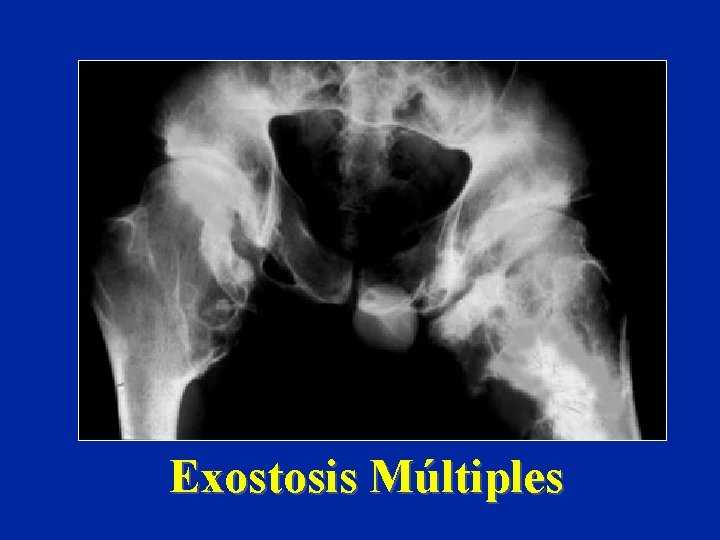 Exostosis Múltiples 