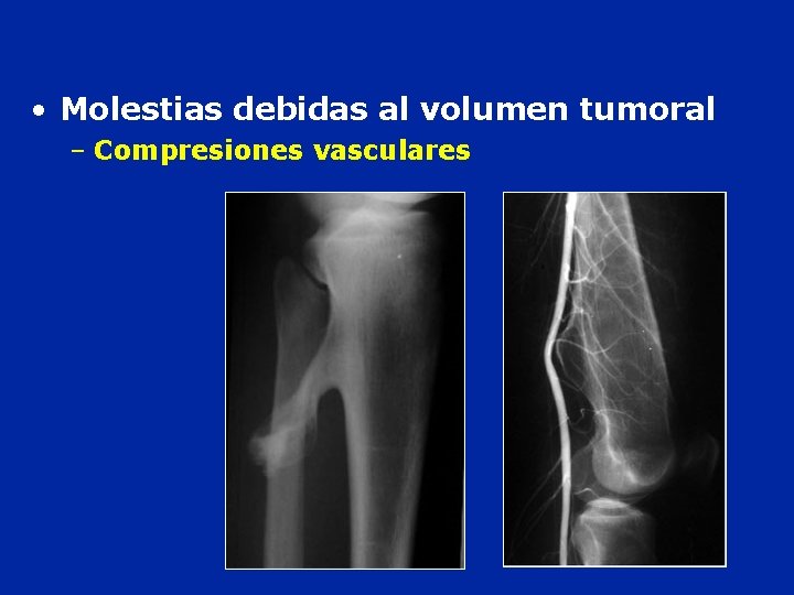  • Molestias debidas al volumen tumoral – Compresiones vasculares 