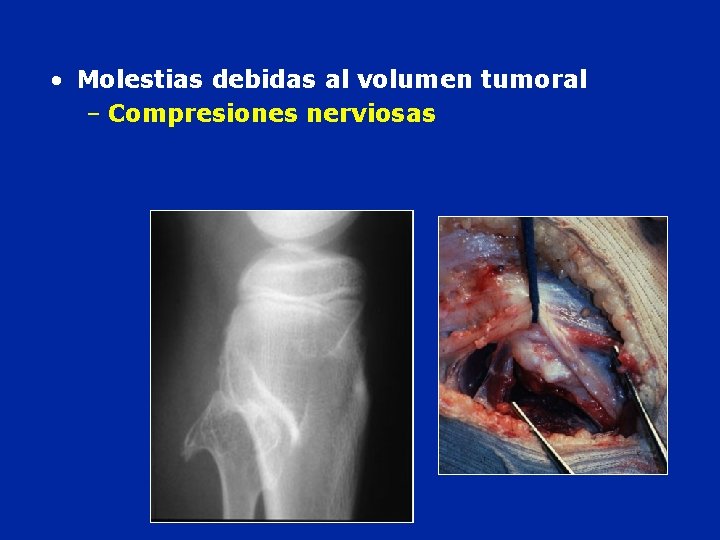  • Molestias debidas al volumen tumoral – Compresiones nerviosas 