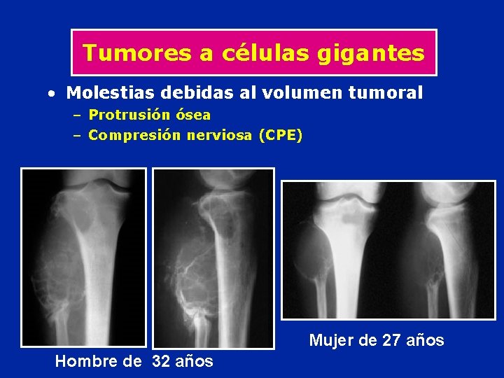 Tumores a células gigantes • Molestias debidas al volumen tumoral – Protrusión ósea –