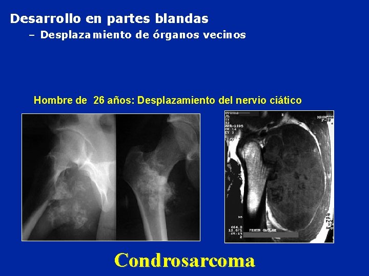 Desarrollo en partes blandas – Desplazamiento de órganos vecinos Hombre de 26 años: Desplazamiento