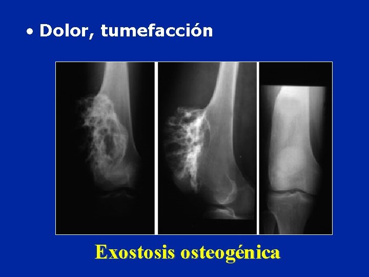  • Dolor, tumefacción Exostosis osteogénica 