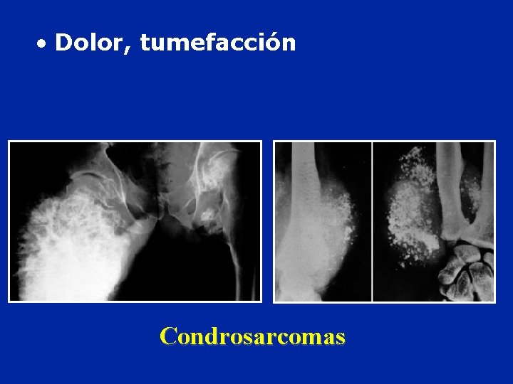  • Dolor, tumefacción Condrosarcomas 