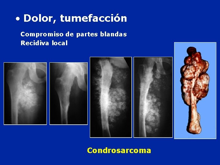  • Dolor, tumefacción Compromiso de partes blandas Recidiva local Condrosarcoma 
