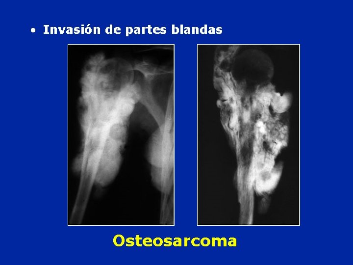  • Invasión de partes blandas Osteosarcoma 