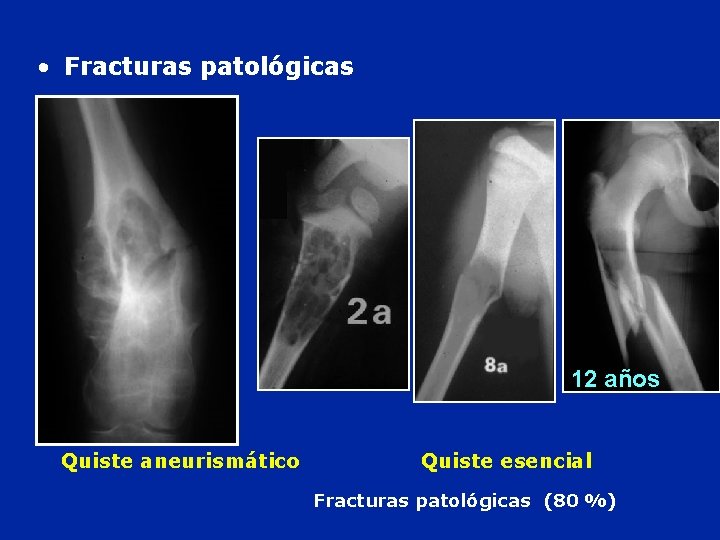  • Fracturas patológicas ans 12 12 años Quiste aneurismático Quiste esencial Fracturas patológicas