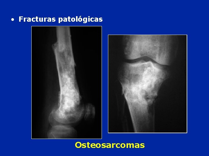  • Fracturas patológicas Osteosarcomas 