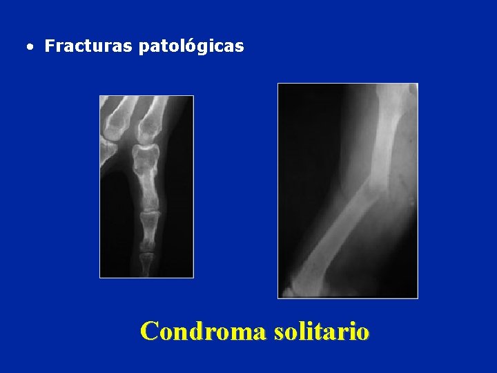  • Fracturas patológicas Condroma solitario 