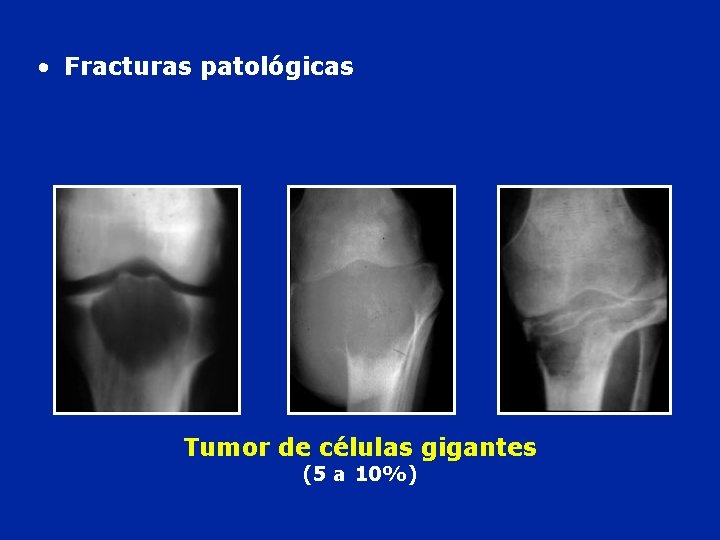  • Fracturas patológicas Tumor de células gigantes (5 a 10%) 