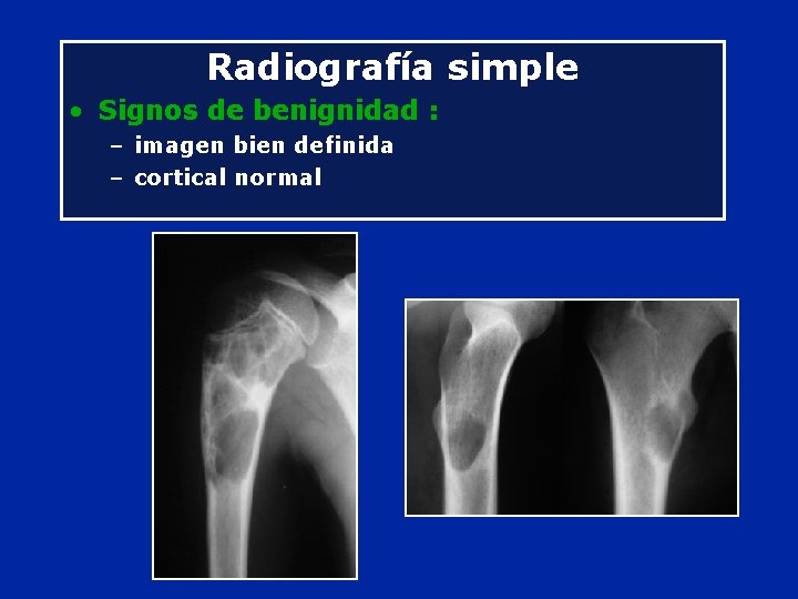 Radiografía simple • Signos de benignidad : – imagen bien definida – cortical normal