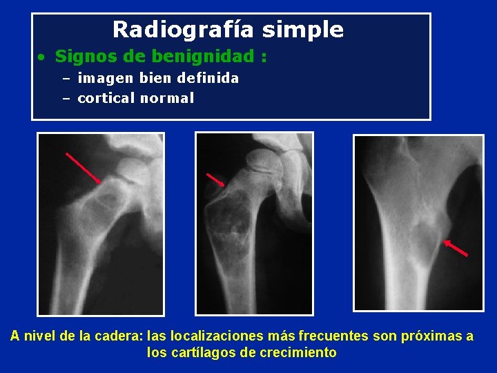 Radiografía simple • Signos de benignidad : – imagen bien definida – cortical normal