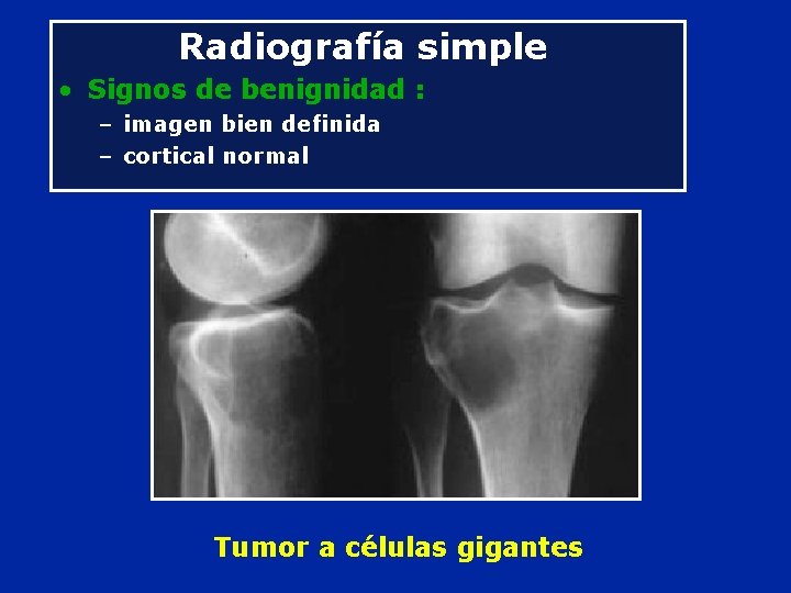 Radiografía simple • Signos de benignidad : – imagen bien definida – cortical normal