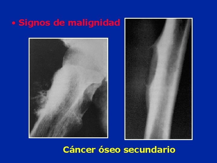  • Signos de malignidad Cáncer óseo secundario 