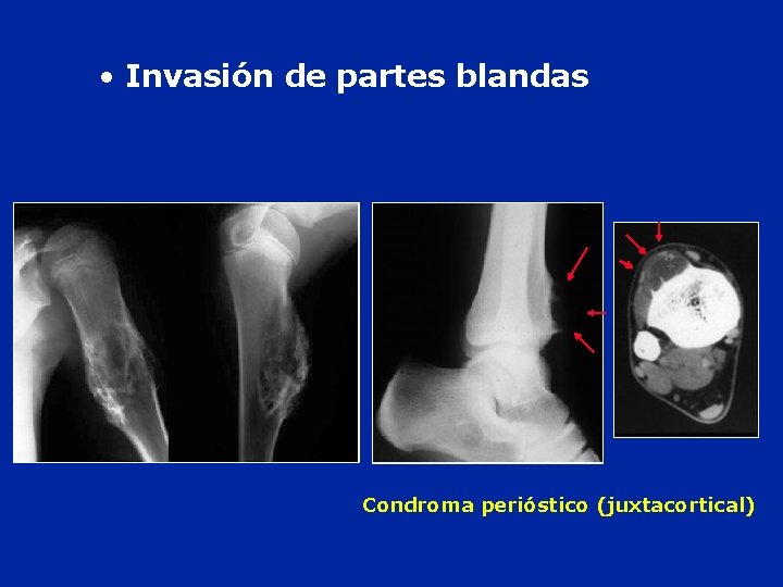 • Invasión de partes blandas Condroma perióstico (juxtacortical) • Invasión de partes blandas Condroma perióstico (juxtacortical)