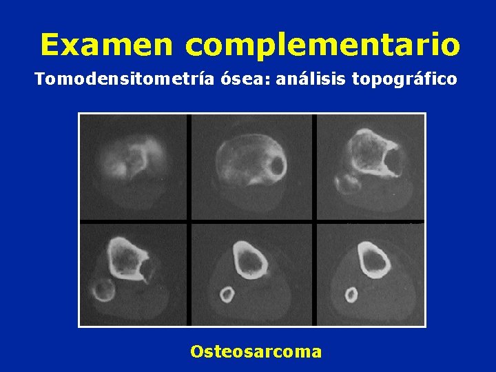 Examen complementario Tomodensitometría ósea: análisis topográfico Osteosarcoma 