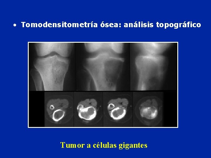  • Tomodensitometría ósea: análisis topográfico Tumor a células gigantes 