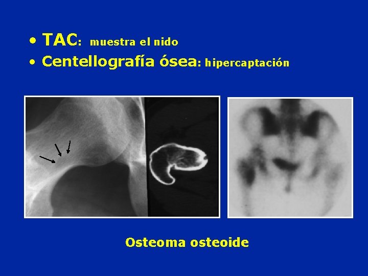  • TAC: muestra el nido • Centellografía ósea: hipercaptación Osteoma osteoide 