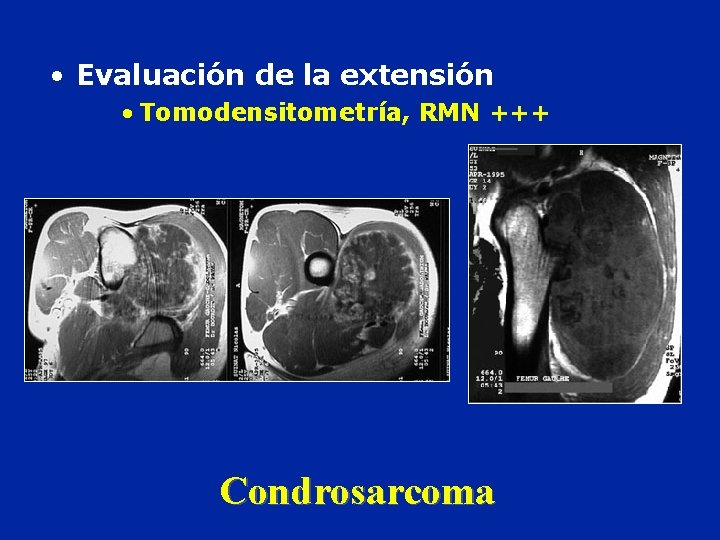  • Evaluación de la extensión • Tomodensitometría, RMN +++ Condrosarcoma 