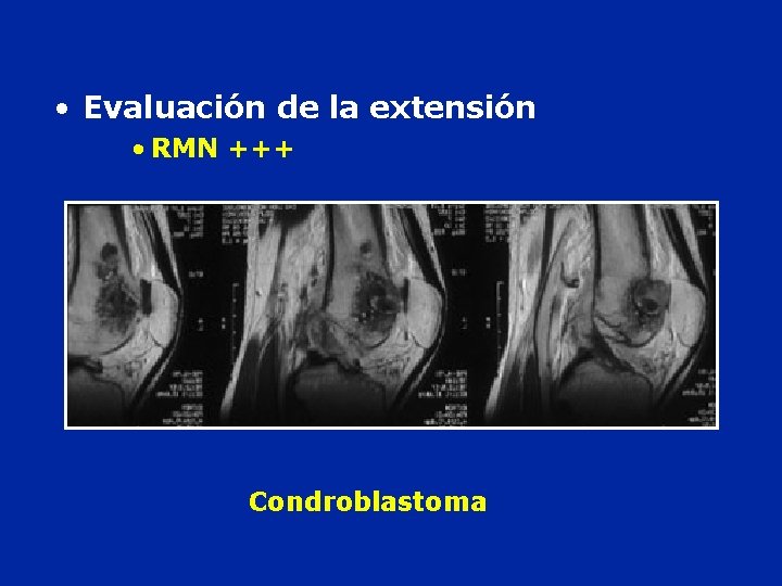  • Evaluación de la extensión • RMN +++ Condroblastoma 