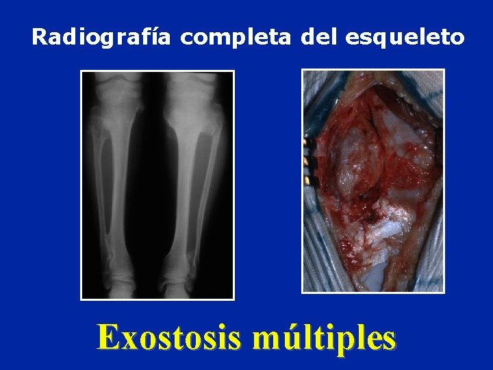 Radiografía completa del esqueleto Exostosis múltiples 