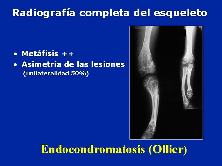 Radiografía completa del esqueleto • Metáfisis ++ • Asimetría de las lesiones (unilateralidad 50%)