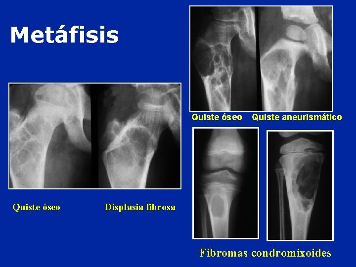 Metáfisis Quiste óseo Quiste aneurismático Displasia fibrosa Fibromas condromixoides 