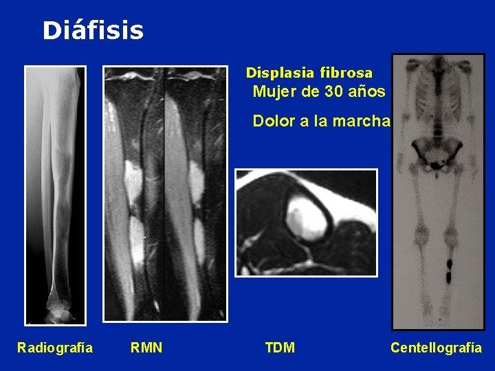 Diáfisis Displasia fibrosa Mujer de 30 años : Dolor a la marcha Radiografía RMN