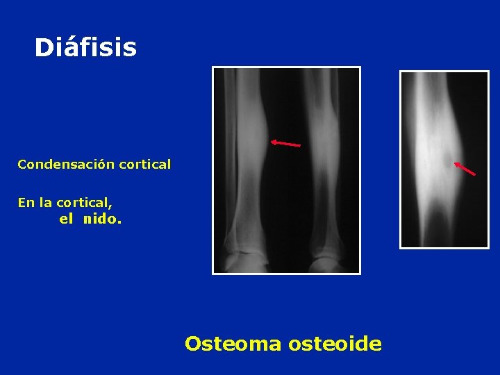 Diáfisis Condensación cortical En la cortical, el nido. Osteoma osteoide 