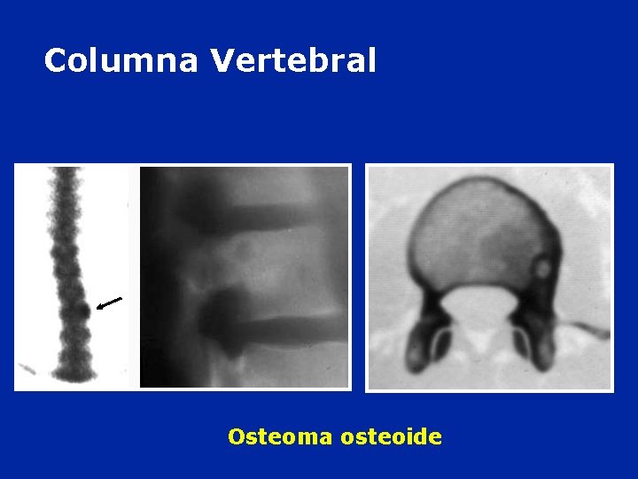 Columna Vertebral Osteoma osteoide 