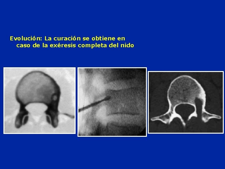 Evolución: La curación se obtiene en caso de la exéresis completa del nido 