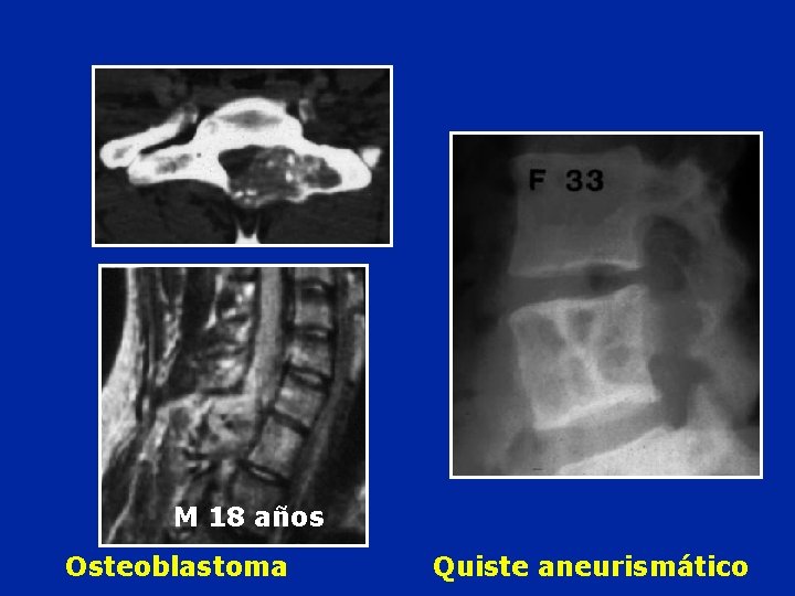 M 18 años Osteoblastoma Quiste aneurismático 