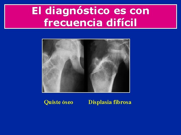 El diagnóstico es con frecuencia difícil Quiste óseo Displasia fibrosa 