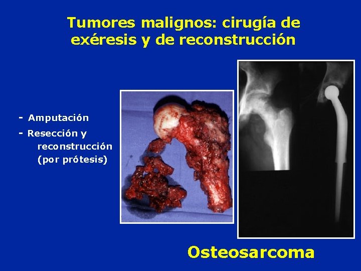Tumores malignos: cirugía de exéresis y de reconstrucción - Amputación - Resección y reconstrucción