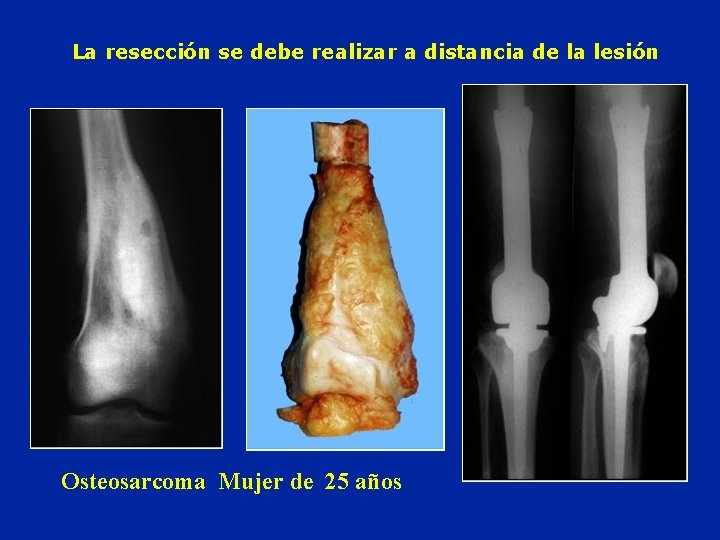 La resección se debe realizar a distancia de la lesión Osteosarcoma Mujer de 25 La resección se debe realizar a distancia de la lesión Osteosarcoma Mujer de 25