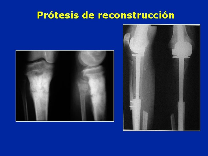 Prótesis de reconstrucción 