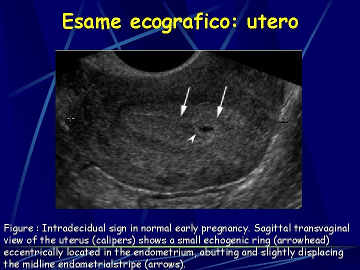 Esame ecografico: utero Figure : Intradecidual sign in normal early pregnancy. Sagittal transvaginal view