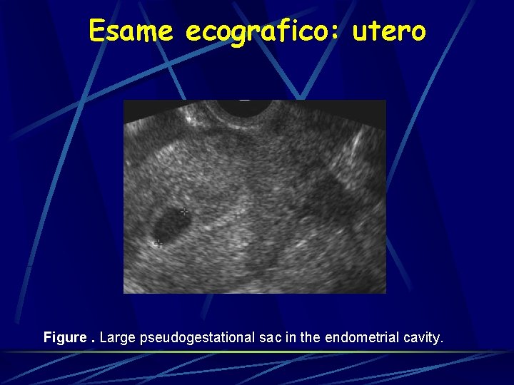 Esame ecografico: utero Figure. Large pseudogestational sac in the endometrial cavity. 