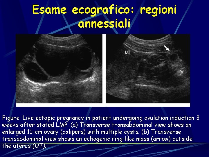 Esame ecografico: regioni annessiali Figure Live ectopic pregnancy in patient undergoing ovulation induction 3