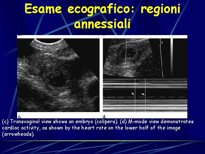 Esame ecografico: regioni annessiali (c) Transvaginal view shows an embryo (calipers). (d) M-mode view