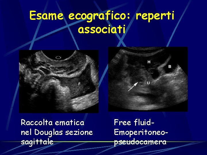 Esame ecografico: reperti associati Raccolta ematica nel Douglas sezione sagittale Free fluid. Emoperitoneopseudocamera 