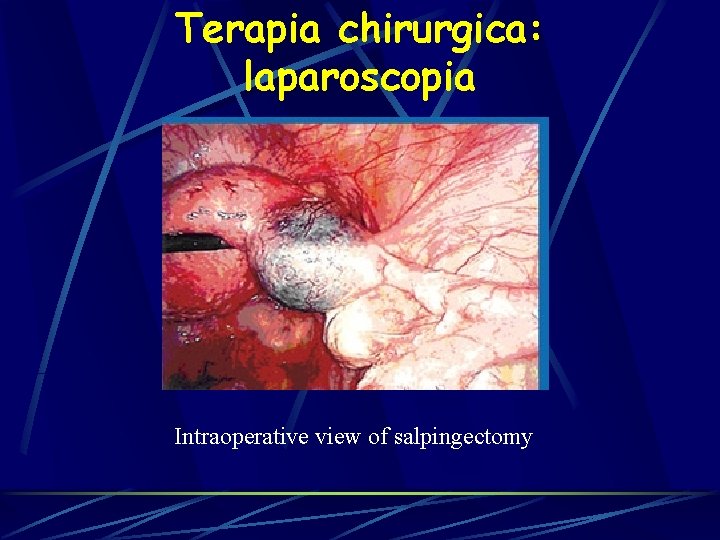 Terapia chirurgica: laparoscopia Intraoperative view of salpingectomy 