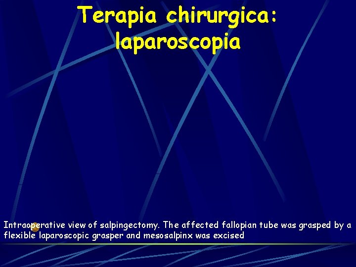 Terapia chirurgica: laparoscopia Intraoperative view of salpingectomy. The affected fallopian tube was grasped by