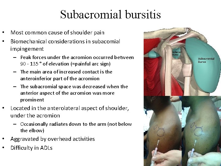 Subacromial bursitis • Most common cause of shoulder pain • Biomechanical considerations in subacomial