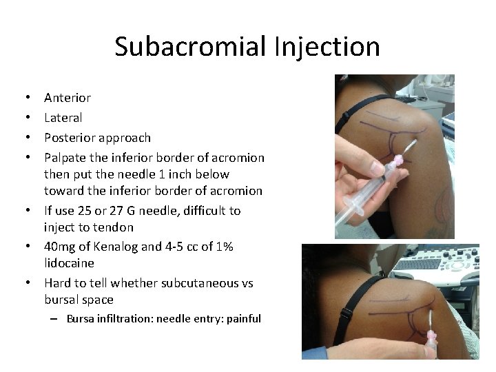 Subacromial Injection Anterior Lateral Posterior approach Palpate the inferior border of acromion then put