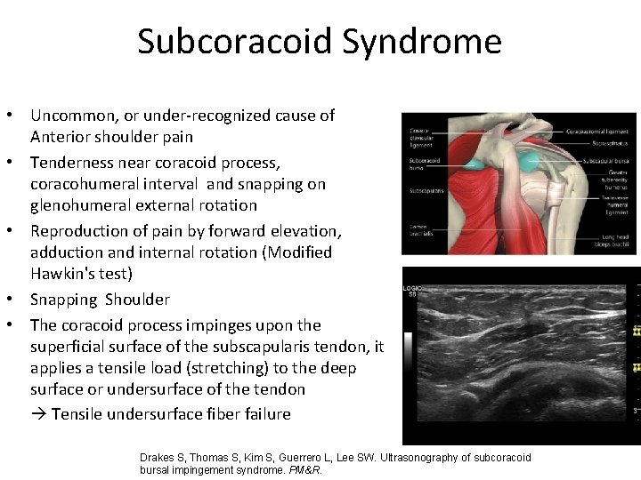 Subcoracoid Syndrome • Uncommon, or under-recognized cause of Anterior shoulder pain • Tenderness near