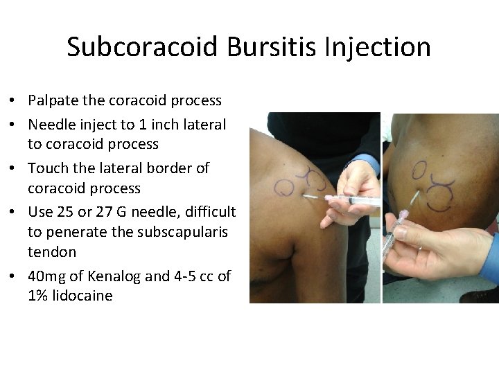 Subcoracoid Bursitis Injection • Palpate the coracoid process • Needle inject to 1 inch