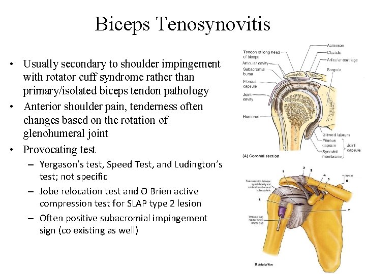 Biceps Tenosynovitis • Usually secondary to shoulder impingement with rotator cuff syndrome rather than