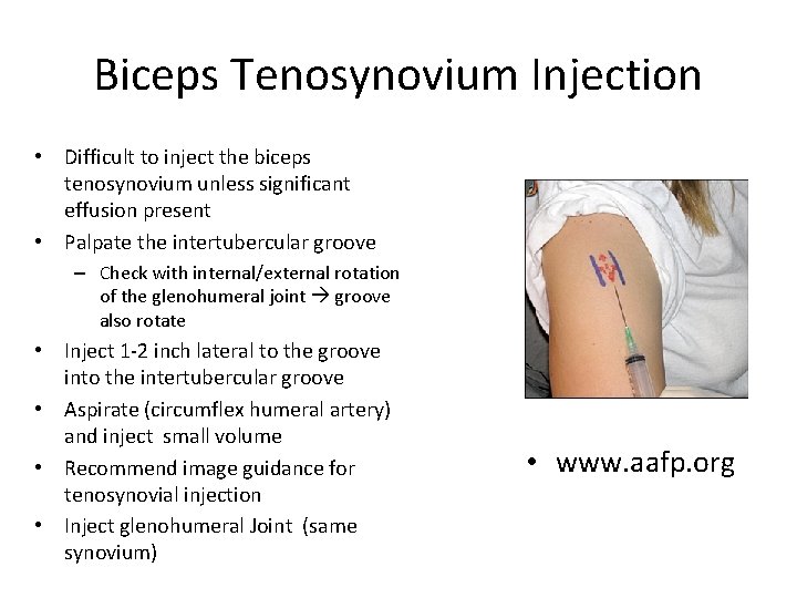Biceps Tenosynovium Injection • Difficult to inject the biceps tenosynovium unless significant effusion present
